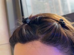 -碧莲盛·不剃发植发