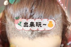 -大麦微针植发全国连锁