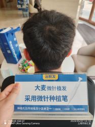 -大麦微针植发丨全国连锁