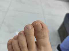 -Andrew指甲专科灰指甲·甲沟炎矫正·3D步态矫形鞋垫定制(浦三路店)