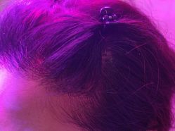 -碧莲盛·不剃发植发