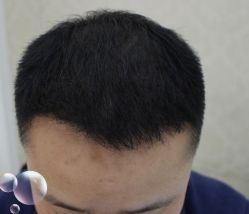 -大麦微针植发丨全国连锁