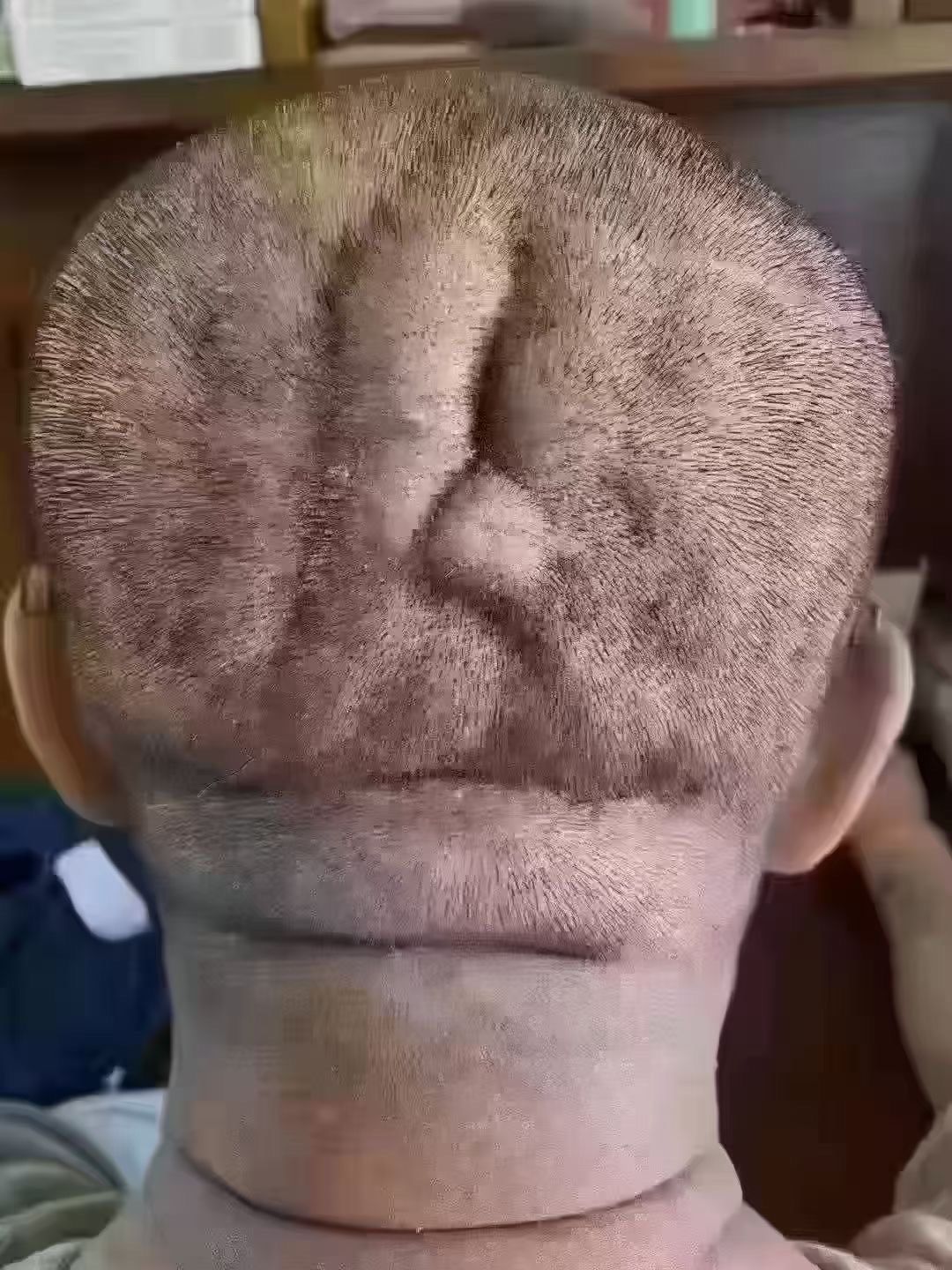 横纹叫脑梗纹
竖纹叫心梗纹