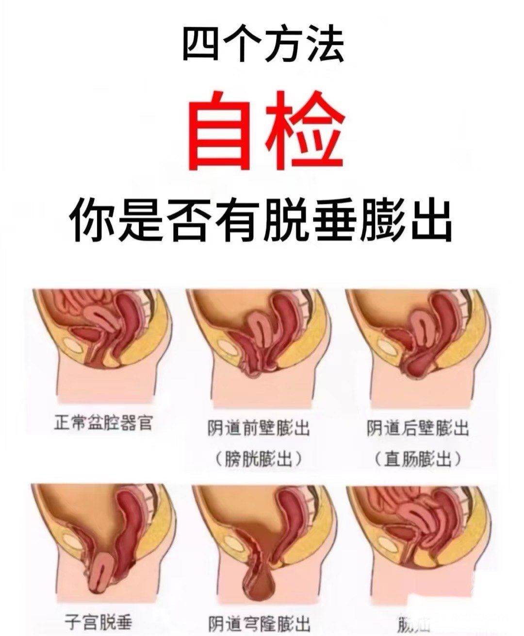 这只能说明盆底肌问题.
2.是否有小腹凸起,小腹部有垂坠感.
3