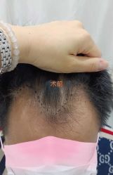 -大麦微针植发全国连锁