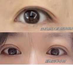 体验前-郡艺医疗美容·微整·眼鼻吸脂