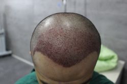 点击看大图 -大麦微针植发丨全国连锁