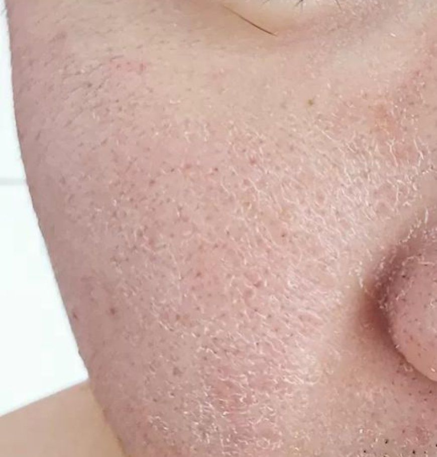 为什么一入冬皮肤就干"爆皮"?