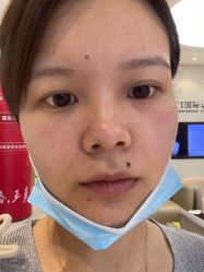 体验后-Yestar宁波艺星整形医院