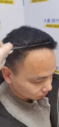 -大麦微针植发丨全国连锁