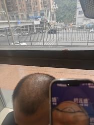 -碧莲盛·不剃发植发