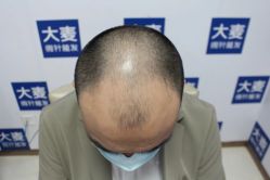-大麦微针植发丨全国连锁