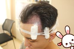 -大麦微针植发丨全国连锁