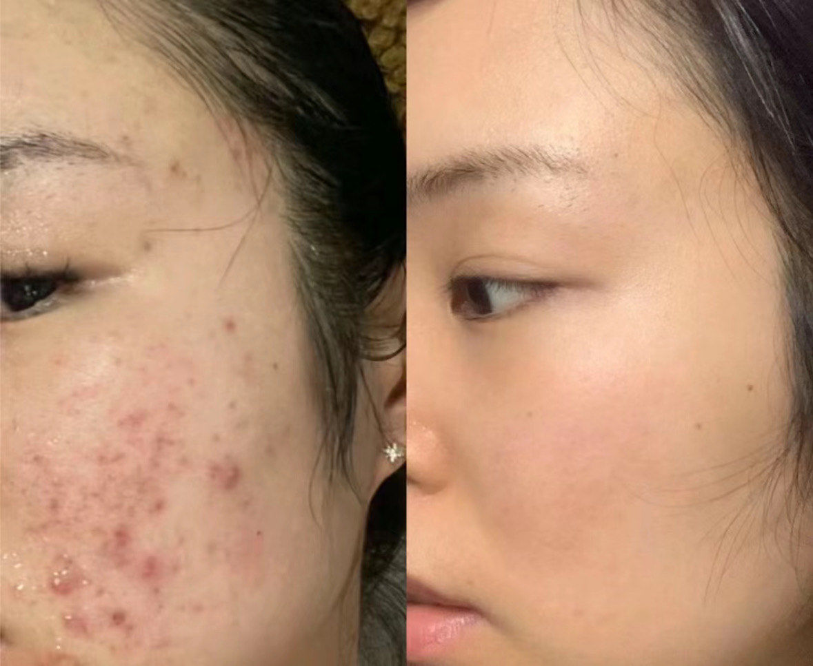 袪痘対比🆚
🤭热乎乎的案例 祛痘前后对比图
我家小姐姐看到