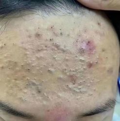 -瑶芳清颜草本祛痘