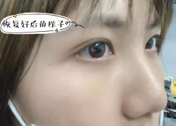 -天津健丽·去眼袋医疗美容机构