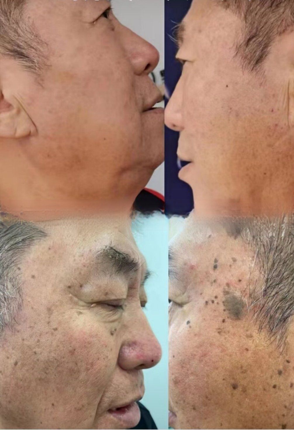 面部扁平疣是皮肤型的hpv感染,跟宫颈病