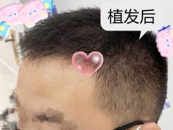 -大麦微针植发全国连锁