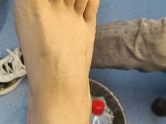 -祖传修脚甲沟炎灰指甲鸡眼
