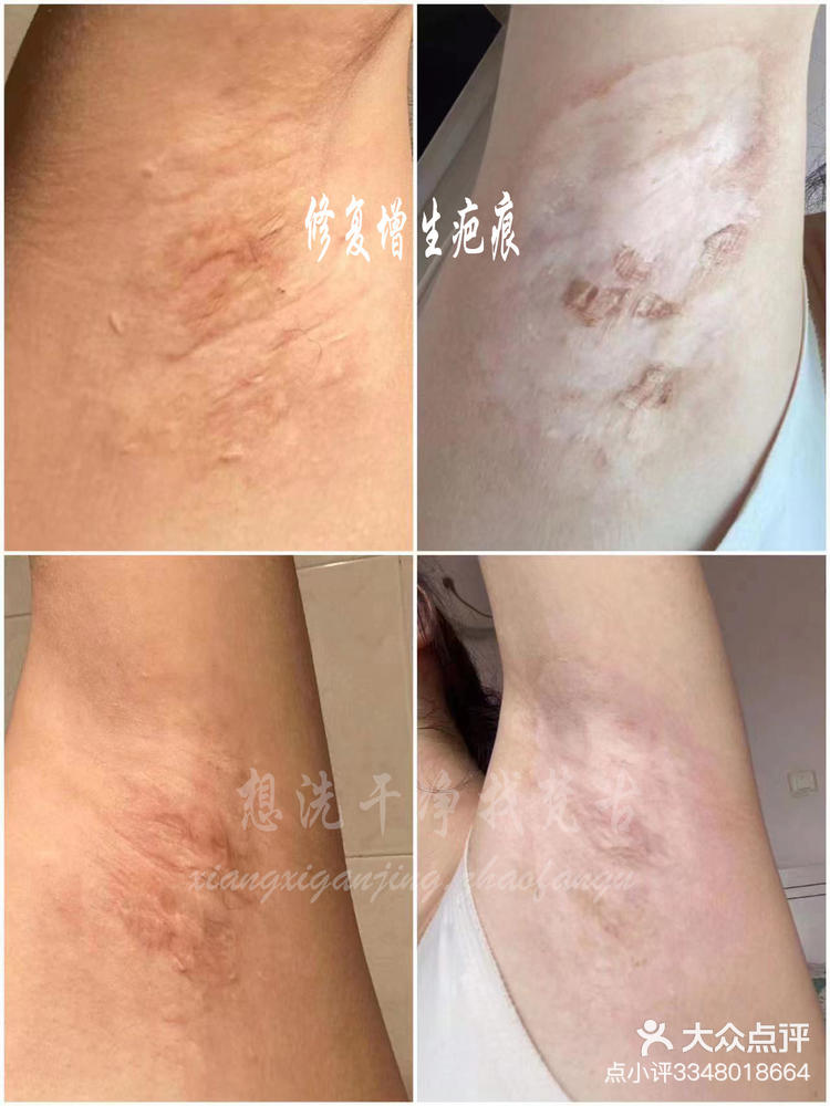 腋下增生疤痕修复～美女5年多的腋下手术-大众点评