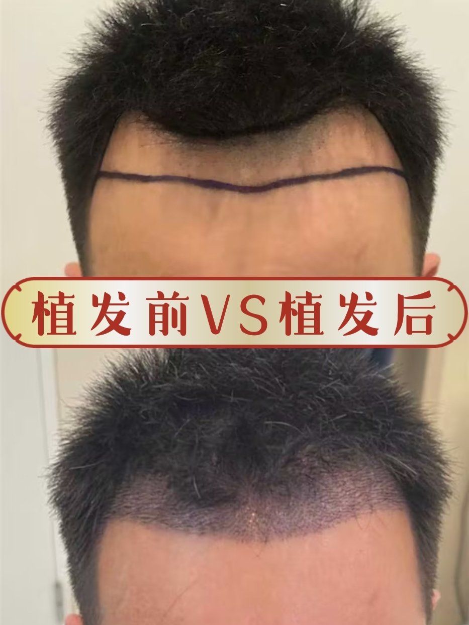 植发术后半年效果分享