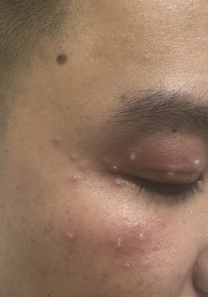 脸上涨了好多疣一直困扰我,今天下班正好同