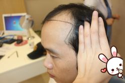 -大麦微针植发丨全国连锁