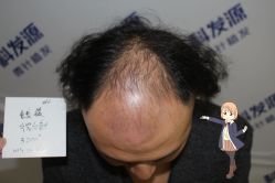 -大麦微针植发丨全国连锁