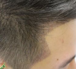 -大麦微针植发丨全国连锁