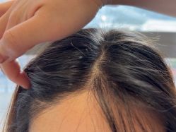 -碧莲盛·不剃发植发