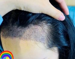 -大麦微针植发丨全国连锁