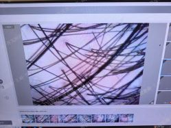 -碧莲盛·不剃发植发