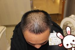 点击看大图 -大麦微针植发丨全国连锁