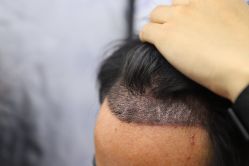 -大麦微针植发丨全国连锁