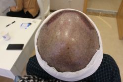 -大麦微针植发丨全国连锁