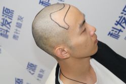 点击看大图 -大麦微针植发丨全国连锁