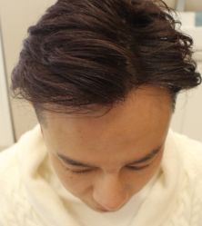 -大麦微针植发全国连锁