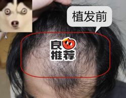 -大麦微针植发全国连锁