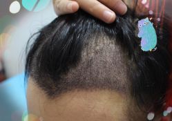 -大麦微针植发全国连锁