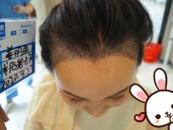 -大麦微针植发丨全国连锁