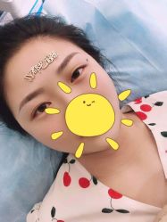 体验后-郡艺医疗美容·微整·眼鼻吸脂