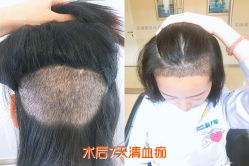 -大麦微针植发丨全国连锁