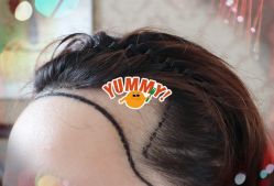 -大麦微针植发全国连锁