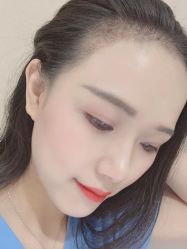 -大麦微针植发全国连锁