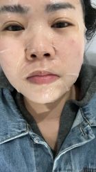 体验后-洁铭新加坡医美