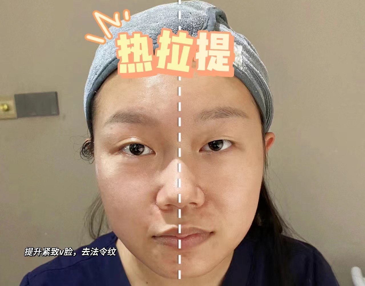 黄金热拉提多久做一次结果
最好_黄金热拉提的原理和功效