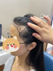 -大麦微针植发全国连锁