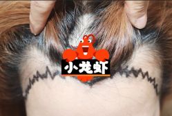 -大麦微针植发全国连锁