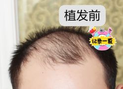 -大麦微针植发全国连锁