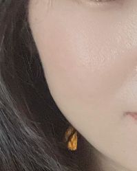 点击看大图 体验前-美瑞莎创美医疗美容